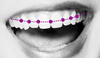 Orthodontie met esthetische brackets 