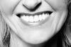 Orthodontie met een onzichtbare beugel
